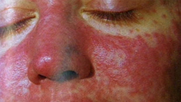 Photo of Region must boost surveillance to prevent measles outbreak – PAHO