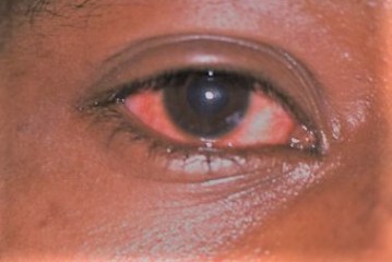 Photo of Region on alert over spread of ‘red eye’